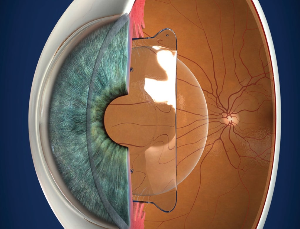 Zien zonder bril - Lensimplantatie ICL